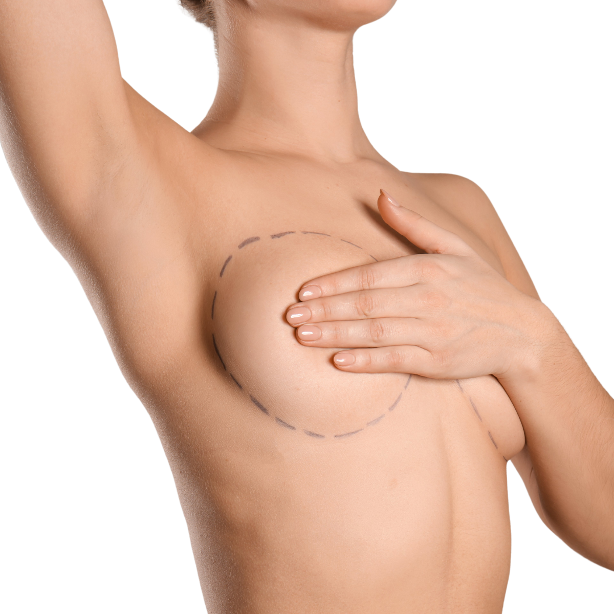 SB Hybrid Breast Augmentation