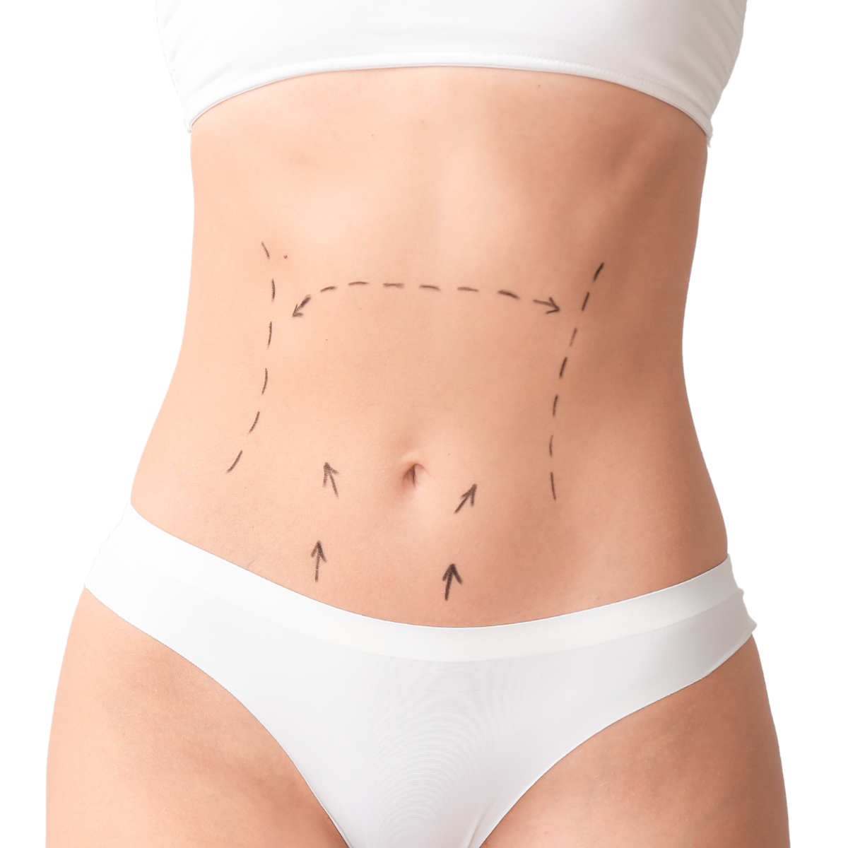 SB Tummy Tuck (Abdominoplasty)